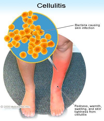 cellulitis icd 10|icd 10 cellulitis both legs.